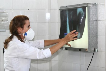 Brasil tem 34% dos casos de coinfecÃ§Ã£o de tuberculose e HIV do mundo